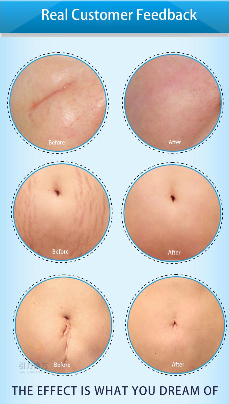 Scar Cream,Professional Scar Removal Gel,Suitable for scar removal treatment of post-operative scars,Caesarean section scars,Keloids,Burns,Acne