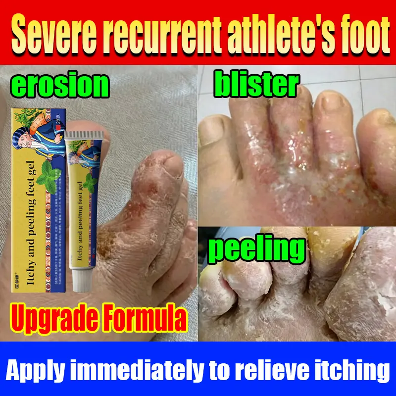 This foot type antibacterial and anti itch ointment can effectively relieve foot itching, foot odor, peeling blisters, and erosion between toes caused by athlete's foot. It is a herbal foot cream.