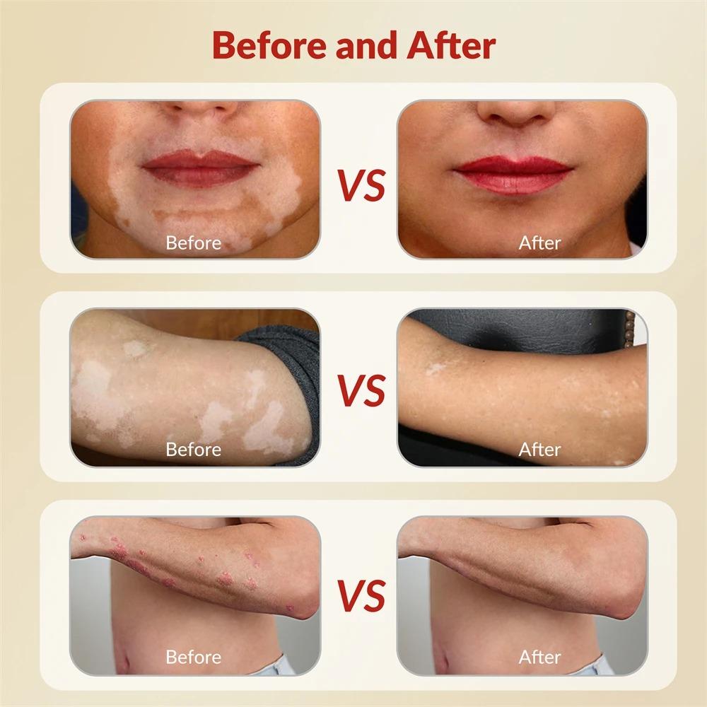 ZJZK 6 Diodes 308nm UVB Excimer Phototherapy Device, 35mW/cm² High Energy Density, Handheld Blue Light Skin Treatment, Targeted Therapy for Vitiligo, Psoriasis, Eczema, Atopic Dermatitis, Portable Home Use for Skin Disorders ZJZK 6 Diodes 308nm UVB Excimer Phototherapy Device, 35mW/cm² High Energy Density, Handheld Blue Light Skin Treatment, Targeted Therapy for Vitiligo, Psoriasis, Eczema, Atopic Dermatitis, Portable Home Use for Skin Disorders