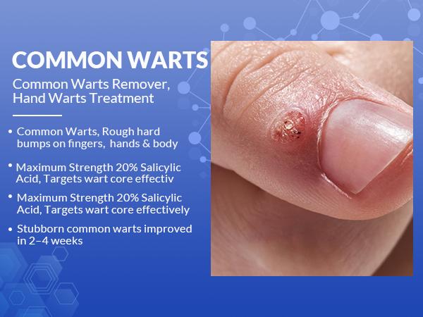 Salicylic Acid 20% Wart Remover Gel, Common & Plantar Wart Treatment, Fast-Drying Formula for External Use, 0.5 Oz (15g) Salicylic Acid 20% Wart Remover Gel, Common & Plantar Wart Treatment, Fast-Drying Formula for External Use, 0.5 Oz (15g)