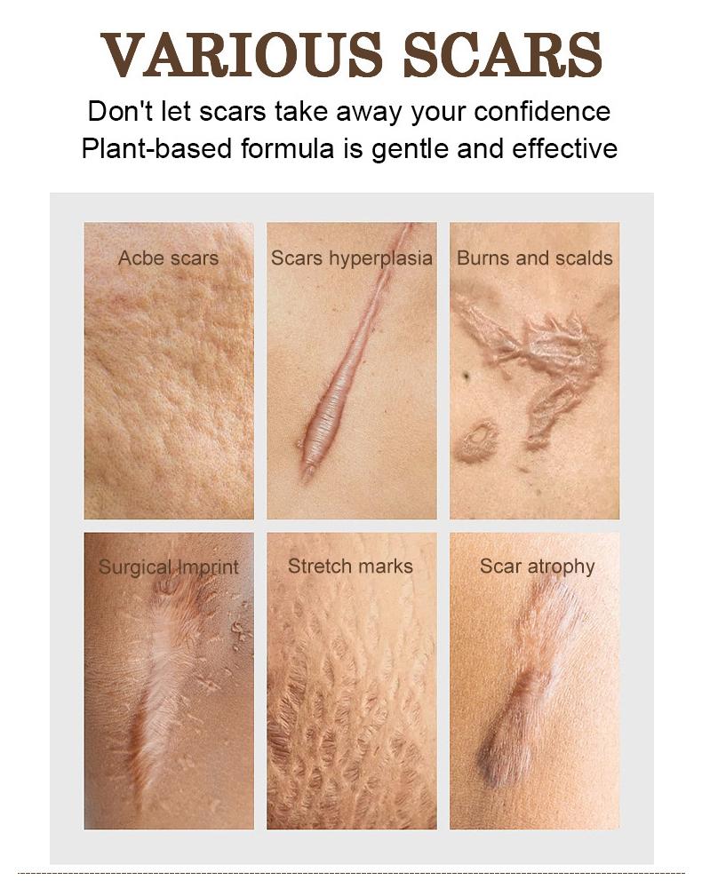 FATAZEN Acne Scar Repair Cream Centella Asiatica Fade Scars, Acne Marks, Brightens Skin Tone Skin Repair Skincare