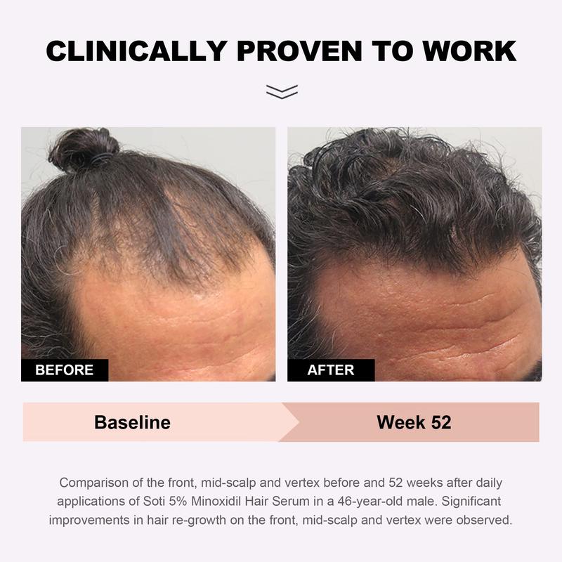 Soti Minoxidil 5% Hair Growth, Hair Loss Regrowth Serum. Dermatologists Recommended. Ginseng and Biotin Extra Strength Formula. (6 Packs)