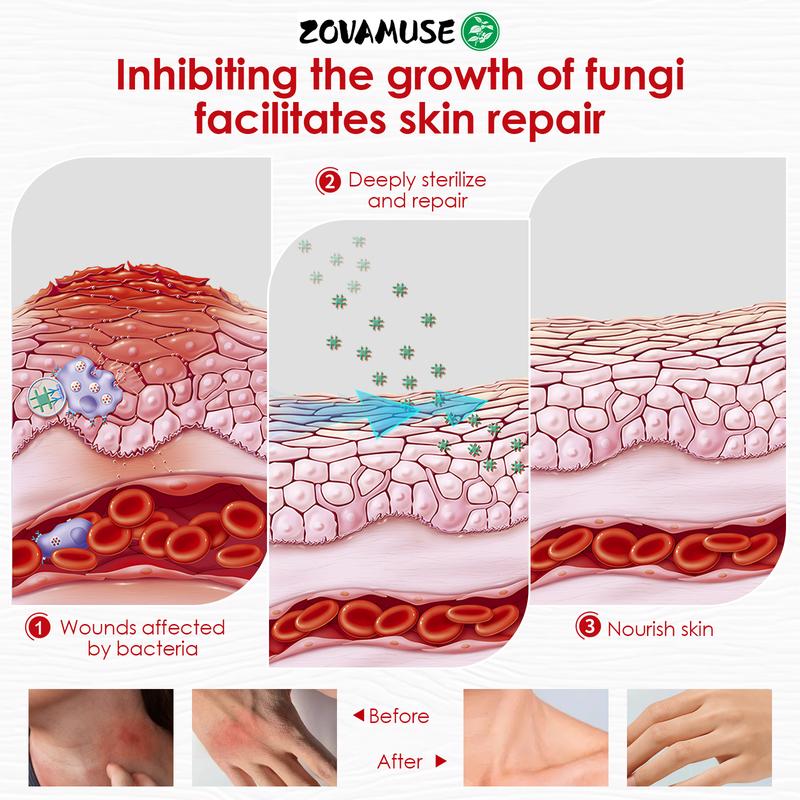 Zovamuse-All-Natural Soothing Cream for Eczema & Psoriasis - Herbal Relief for Dry, Itchy, Sensitive Skin, Anti-Bacterial Skin Defense (Hydrating, Safe for All Ages | 30g) Treatment