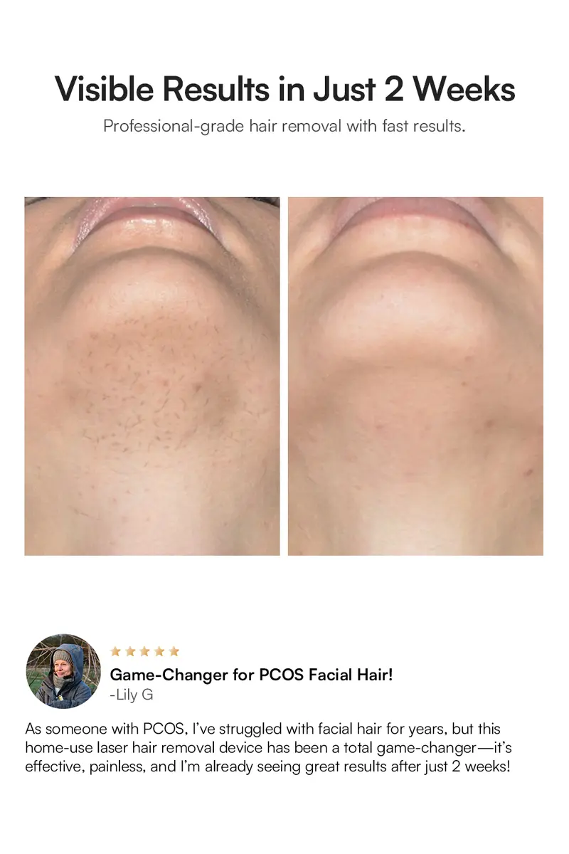 Product Introduction of INIA HAUTE Pro Sapphire Ice-Cooling IPL Hair Removal Device – Painless, FDA Cleared, Full Body & Bikini Use, Long-Lasting Results for Women & Men, 2-Year Warranty – Stay Cool & Smooth, 2