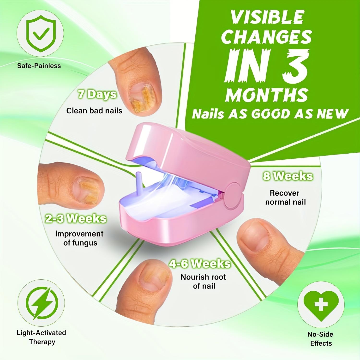 KTS FDA Cleared Nail Fungus Laser Treatment Device 7-Minute Home Care for Hand Toenail Infections Dual-Light Portable Pink Design