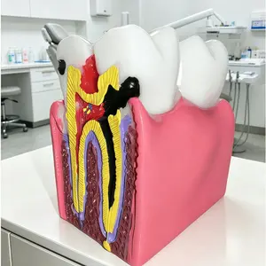 Dental Pathology Anatomy Model, Caries Pulp Lesion Demonstration, Oral Medicine Teaching Aid, Root Canal Structure Display, Dental Communication Tool