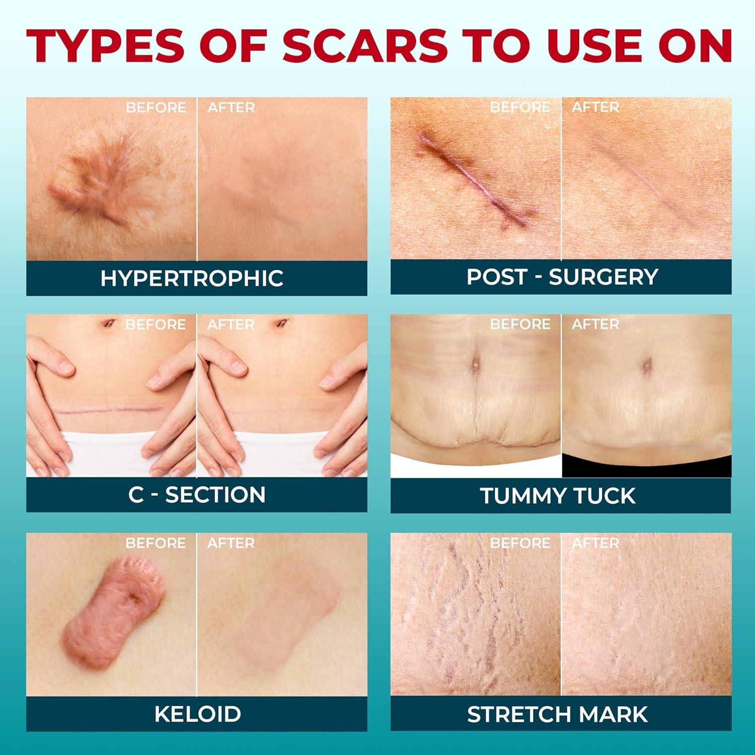 [Buy 1 Get 1 Free]Silicone Scar Sheets(1.6"X 59" Roll-1.5M), Silicone Scar Repair Cream, Silicone Scar Tape, Silicone Scar Strips, Professional Scar Removal Sheets for C-Section, Acne, Buruns & Keloids