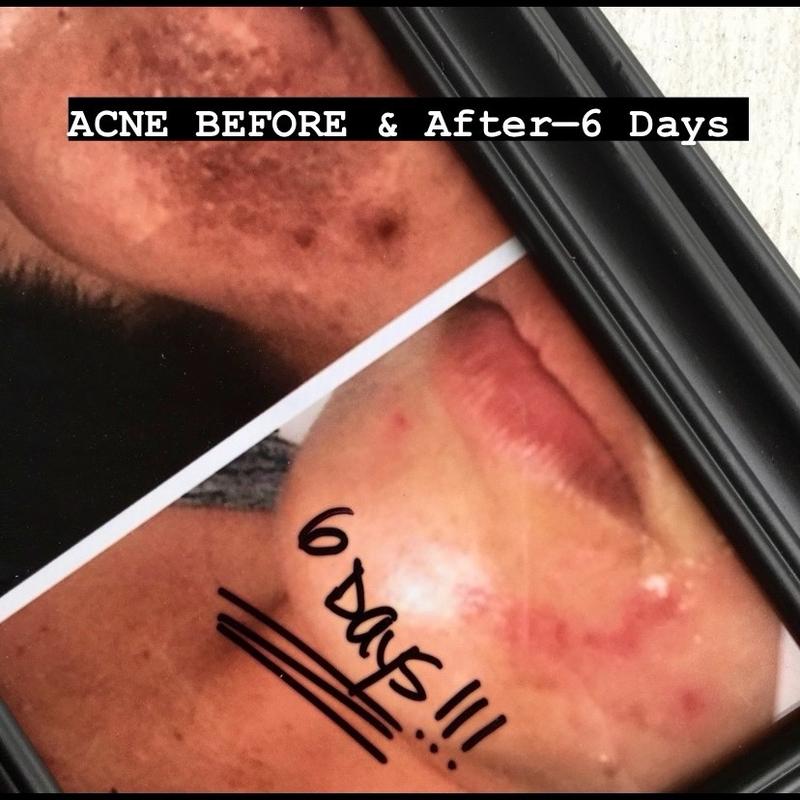 Miracle Healing Balm w/ castor, coconut, frankincense, lavender oils, beeswax— apply to skin/affected areas am and pm. Safe, effective homemade therapeutic soothing balm Eczema Acne Sensitive Olive Moisturizing Body Care Avocado Moisturizers