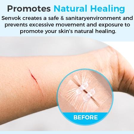 Senvok Butterfly Bandaids for Wound Closure, 2 Pcs Zip Stitch Wound Closure Strips, Surgical Laceration Repair Without Sew - Quick Clot - Emergency Wound Closures Device (PU)