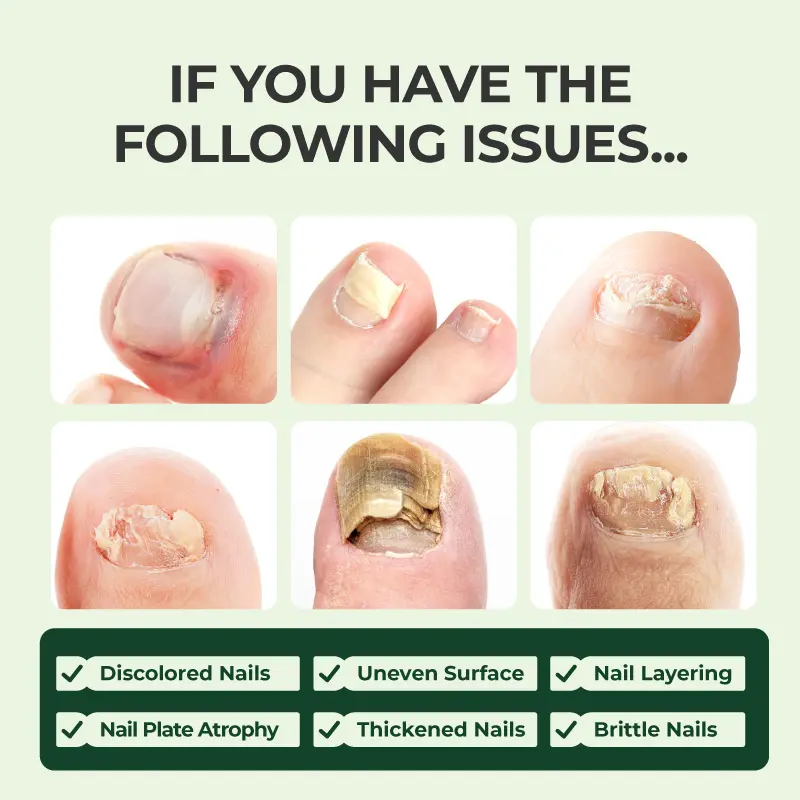Kreain Nature 7 Days Tea Tree & Ginger Nail Treatment for