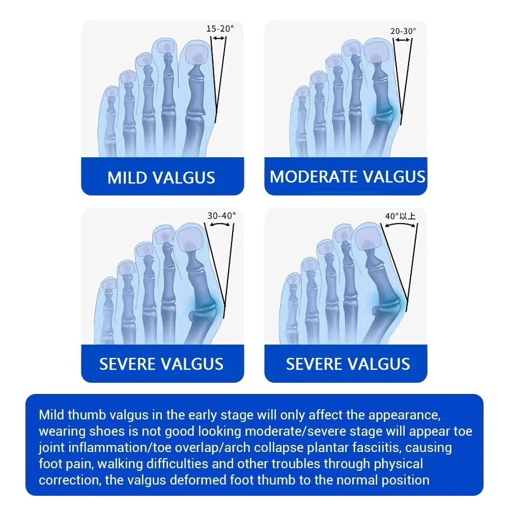 Bunion Corrector for Women Men: Bunion Relief for Big Toe Straightener - Orthopedic Bunion Splint for Pain Relief - Hallux Valgus Correction for Day/Night Support
