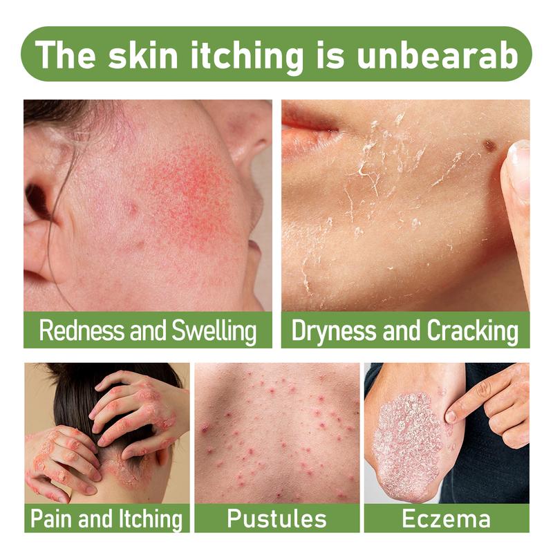 Umex Soothing & Relief Cream with Honeysuckle & Peppermint 30g 100% Natural Plant Extracts Gentle for All Ages Fast Acting Relief for Itching Hydrates Dry Sensitive Skin Therapeutic Treatment for Eczema Psoriasis - Wellness