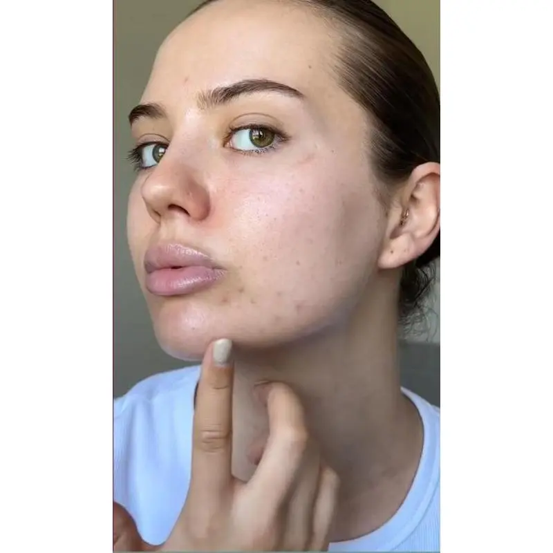 Pore Shrinking Serum Peeling Face Removing Large Pores Tightening Repairing Facial Pore Minimizing Effective Exfoliation Skin