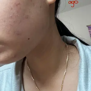 Product Review of Lion Pair Acne Cream Acne Treatment Pimples Removal Cream Pair Acne Creamy Foam Facial Wash Gentle Antibacterial from u**3