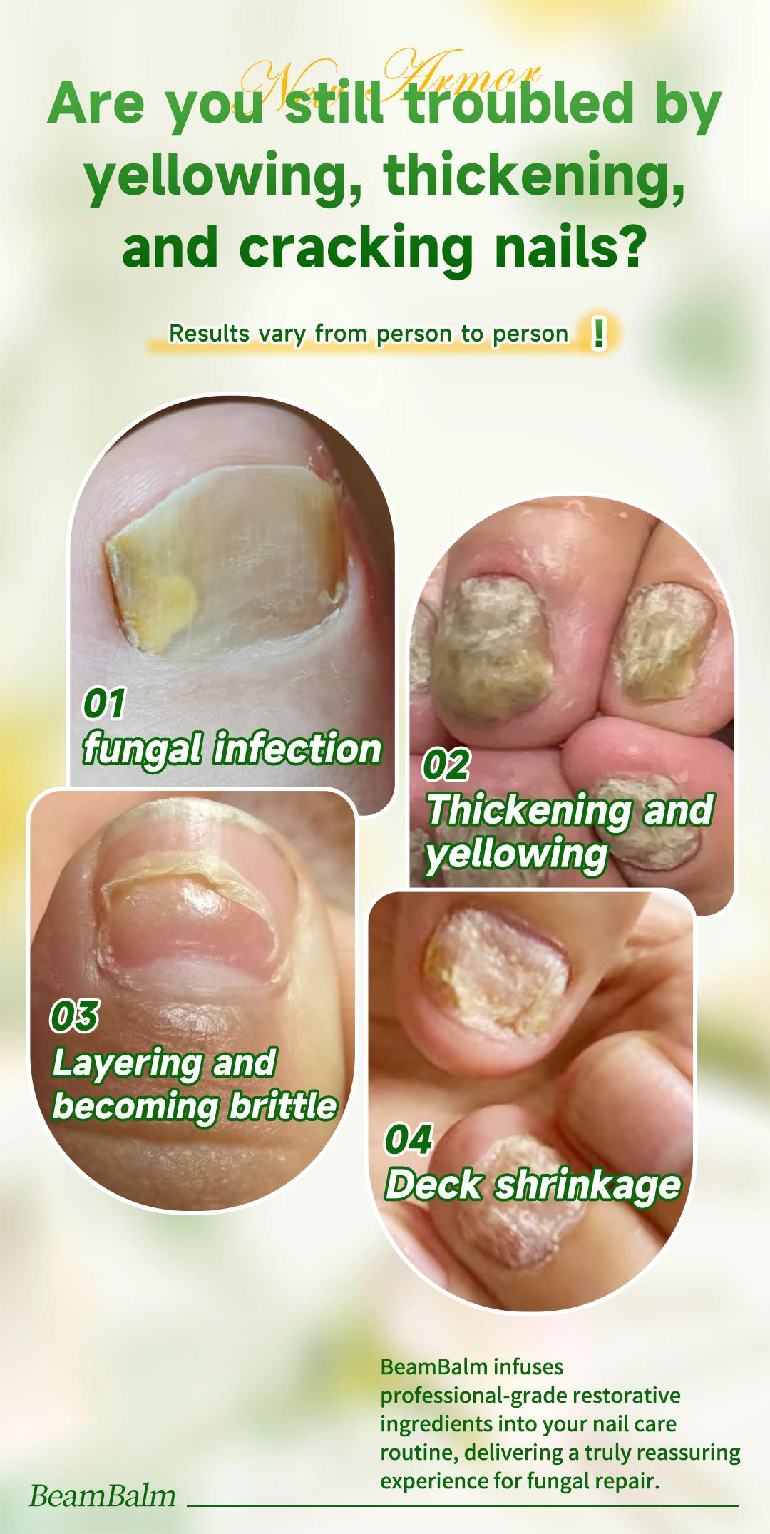 【Special effects】Toenail Fungus Extra Strength,Antifungal Solution for Toenail or Fingernail, Triple ActionFormula for Remove Fungal, Repair and Renewal DamagedNails. 【Special effects】Toenail Fungus Extra Strength,Antifungal Solution for Toenail or Fingernail, Triple ActionFormula for Remove Fungal, Repair and Renewal DamagedNails.
