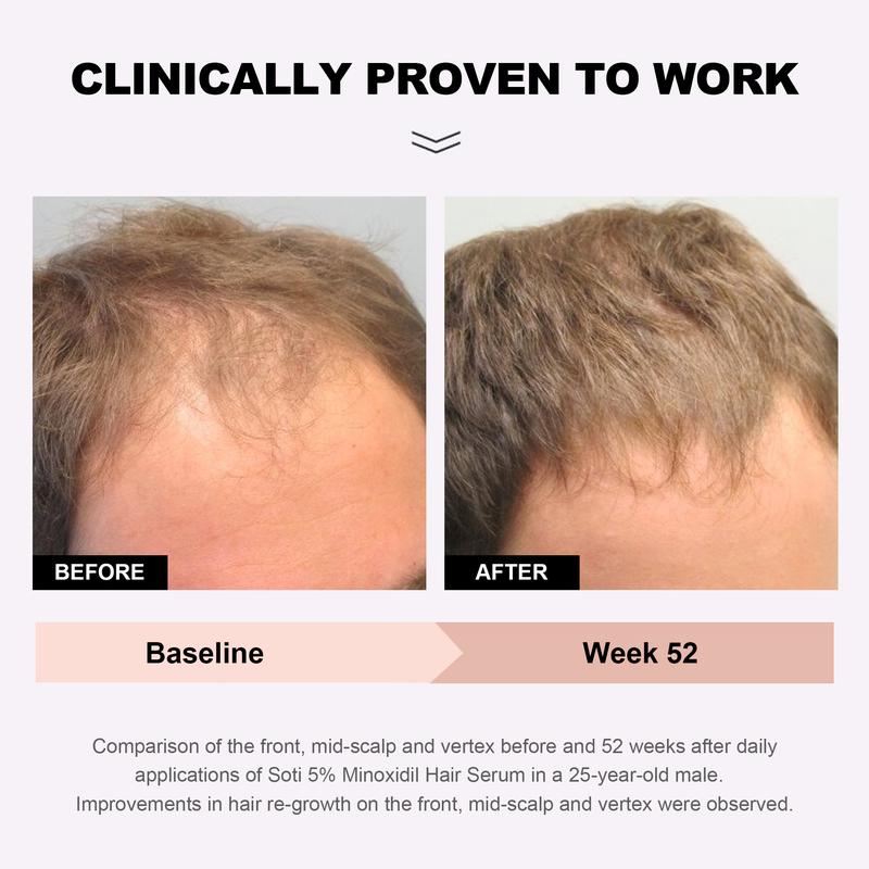5% Minoxidil Hair Growth (3 months supply), Hair Loss Regrowth Serum 180ml.  Dermatologists Recommended. Ginseng and Biotin Extra Strength Formula