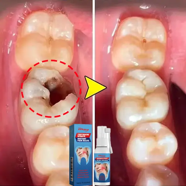 South Moon Toothache Relief Spray: Quick Relief for Toothaches,Cavities, Gum Swelling,and Oral Discomfort Peppermint Gentle zdeer breath spray