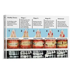 Dental Clinic Wall Poster Periodontal Disease Staging Chart Poster Poster Canvas Wall Art For Bedroom Decor Bar Office Room Decor Gift