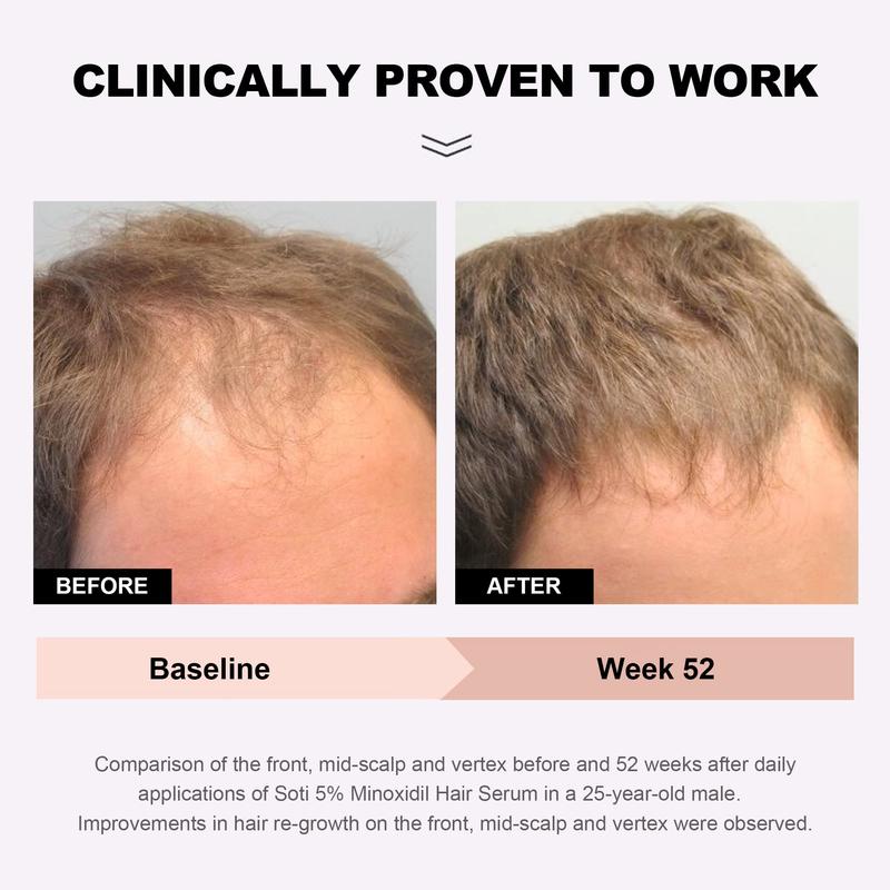 Soti Minoxidil 5% Hair Growth, Hair Loss Regrowth Serum. Dermatologists Recommended. Ginseng and Biotin Extra Strength Formula. (6 Packs)