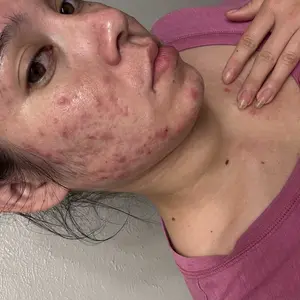 Product Review of Lion Pair Acne Cream Acne Treatment Pimples Removal Cream Pair Acne Creamy Foam Facial Wash Gentle Antibacterial from J**g **