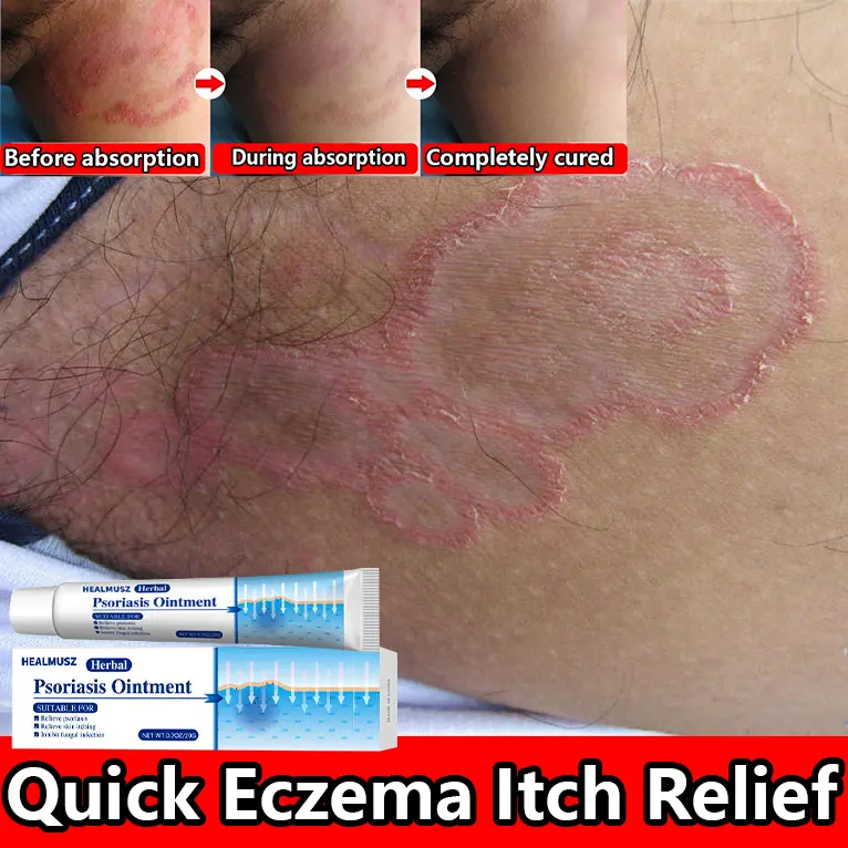 Antifungal & Psoriasis Cream – 100% Natural Plant Formula – Clinically Proven Fast Relief for Itching, Dryness, Redness & Flaking – Treats Psoriasis, Ringworm, Jock Itch, Athlete’s Foot – Deep Hydration, Skin Repair, Prevents Recurrence – 20g