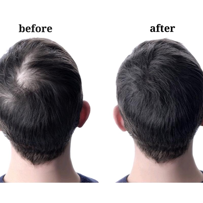 Advanced Hair Growth Treatment (Spray) (NatureProMade