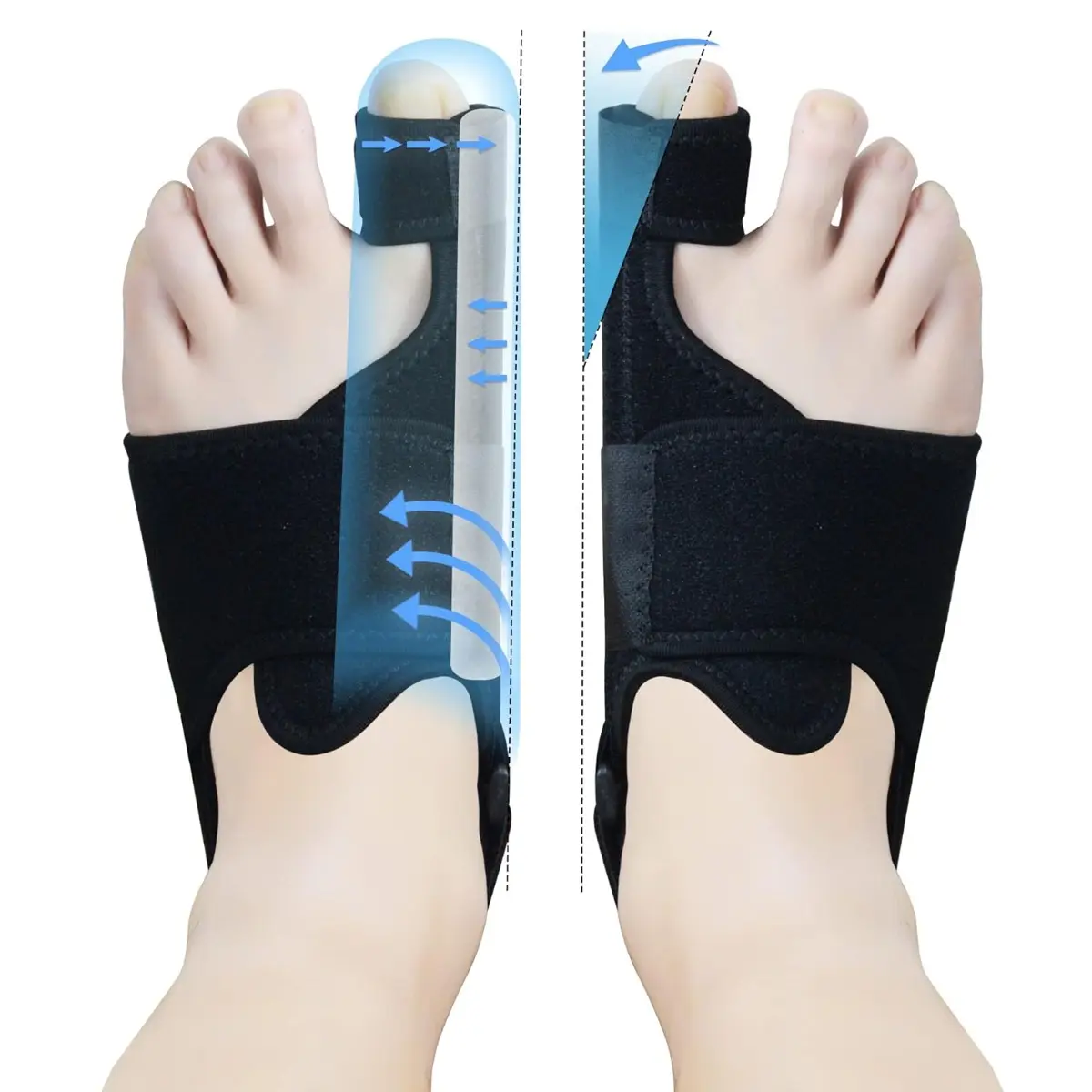 Nighttime Bunion Splint, Unisex Bunion Corrector (1 Pair), Big Toe Corrector, Pain-relieving Bunion Brace.
