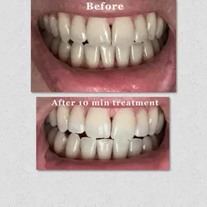 MySmile Pro Teeth Whitening Kit + Refill Pack
