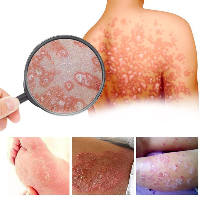 Herbal Antifungal Cream – Soothes Itching from Psoriasis, Eczema, Ringworm, Jock Itch, Athlete’s Foot, Toenail Fungus, Yeast Infection & Tinea – 100% Plant-Based, Steroid-Free – Restores Dry Cracked Skin & Protects Against Recurrence