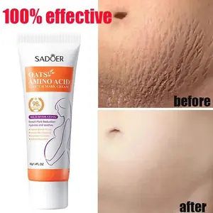 Pregnancy Stretch Mark Cream - Visibly Reduces Marks & Improves Skin Texture | OB-GYN Recommended Formula