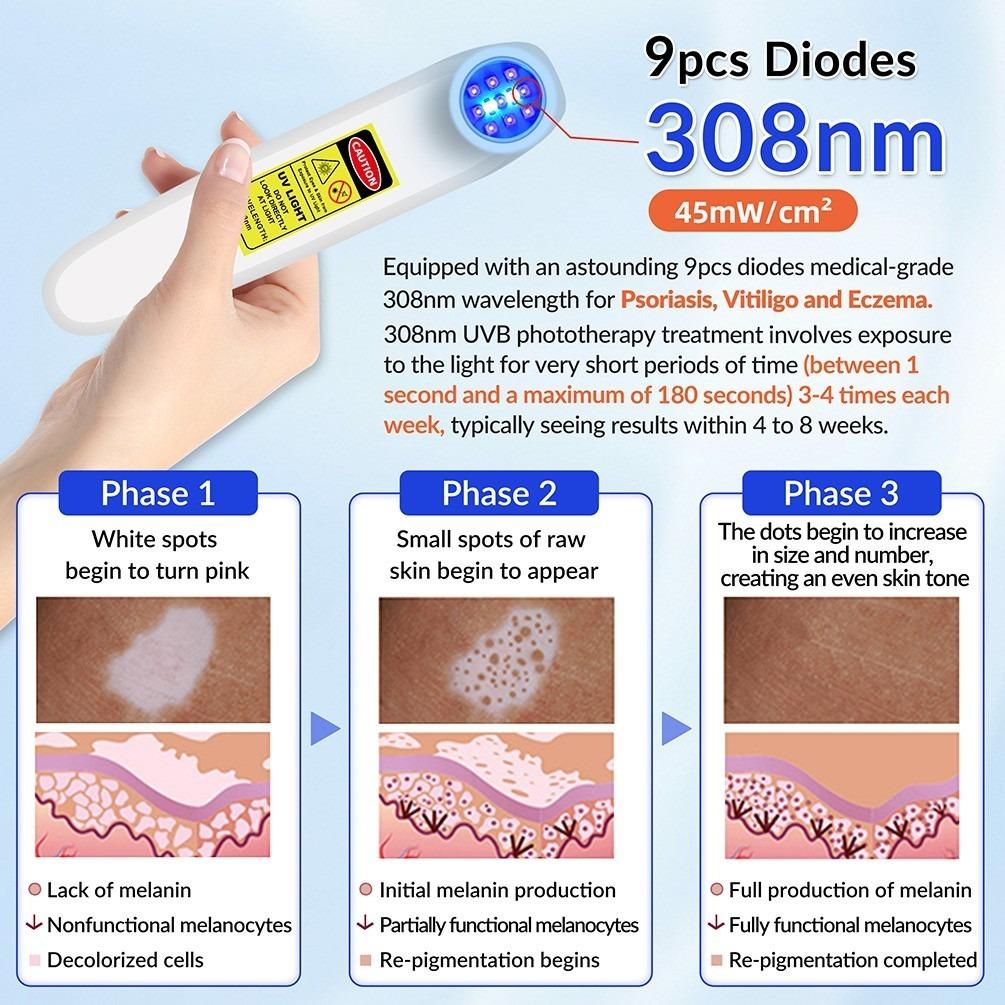 ZJZK 9 Diodes 308nm UVB Excimer Phototherapy Device, 45mW/cm² High Energy Density, Handheld Blue Light Skin Treatment, Targeted Therapy for Vitiligo, Psoriasis, Eczema, Atopic Dermatitis, Portable Home Use for Skin Disorders ZJZK 9 Diodes 308nm UVB Excimer Phototherapy Device, 45mW/cm² High Energy Density, Handheld Blue Light Skin Treatment, Targeted Therapy for Vitiligo, Psoriasis, Eczema, Atopic Dermatitis, Portable Home Use for Skin Disorders