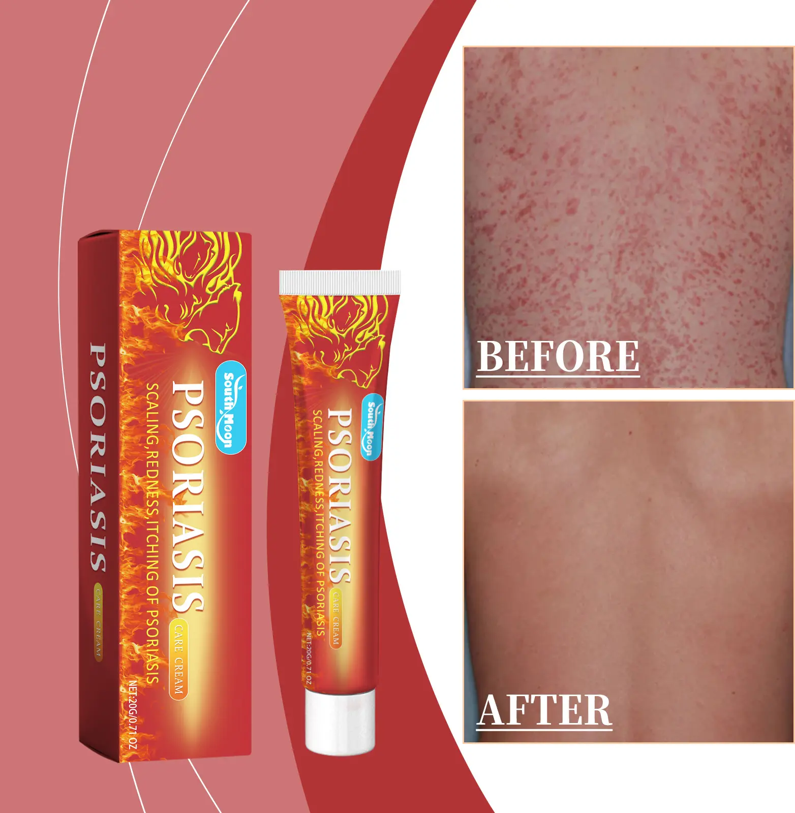 【Premium All-Natural Antifungal Cream】Antifungal Therapy, Tinea Cruris & Tinea Corporis Treatment, Psoriasis Symptom Relief, Skin Irritation Healing & Calming Psoriasis outdoorfun Psoriasis Psoriasis