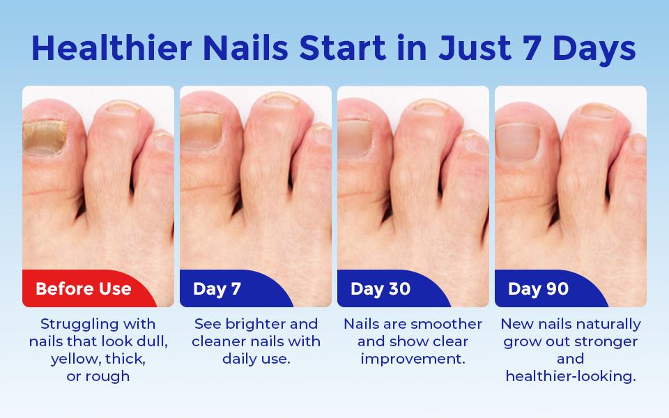 WISHOLY Nail Fungus Treatment for Toenail & Fingernail - Extra Strength Repair Liquid with 1% Tolnaftate, Tea Tree Oil & Oregano Oil - Restores Yellow, Thick & Damaged Nails - 1.01 fl oz