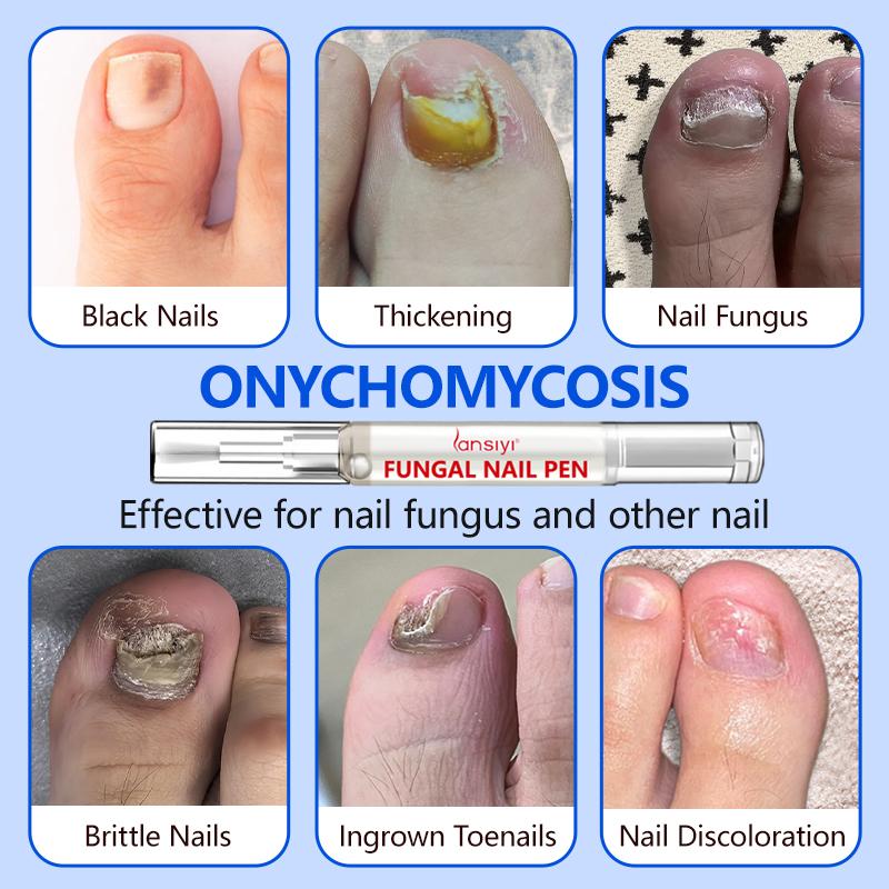 Lansiyi Fungal Nail Pen with Allicin & Undecylenic Acid, Nail Health Care Pen, Nail Fungus Care Pen for Solving Fungal Nails and Other Nail Problems, Nail Supplies Daily Care Nails Kit Set, Nail Tech Supplies,Self Care Tools Lansiyi Fungal Nail Pen with Allicin & Undecylenic Acid, Nail Health Care Pen, Nail Fungus Care Pen for Solving Fungal Nails and Other Nail Problems, Nail Supplies Daily Care Nails Kit Set, Nail Tech Supplies,Self Care Tools