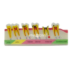 Tooth Decay and Caries Development Demonstration Model