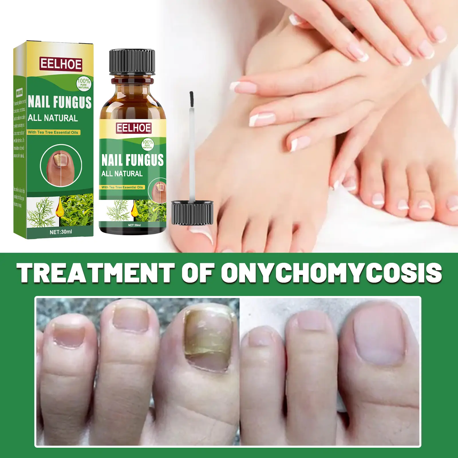 EELHOEToenail Fungus Treatment Extra Strong - Best Nail Fungus Treatment for Nail Repair, Toenail Softener, Yellow Toenail Treatment, Ingrown Nails and Foot Fungus Treatment, Extra Strength