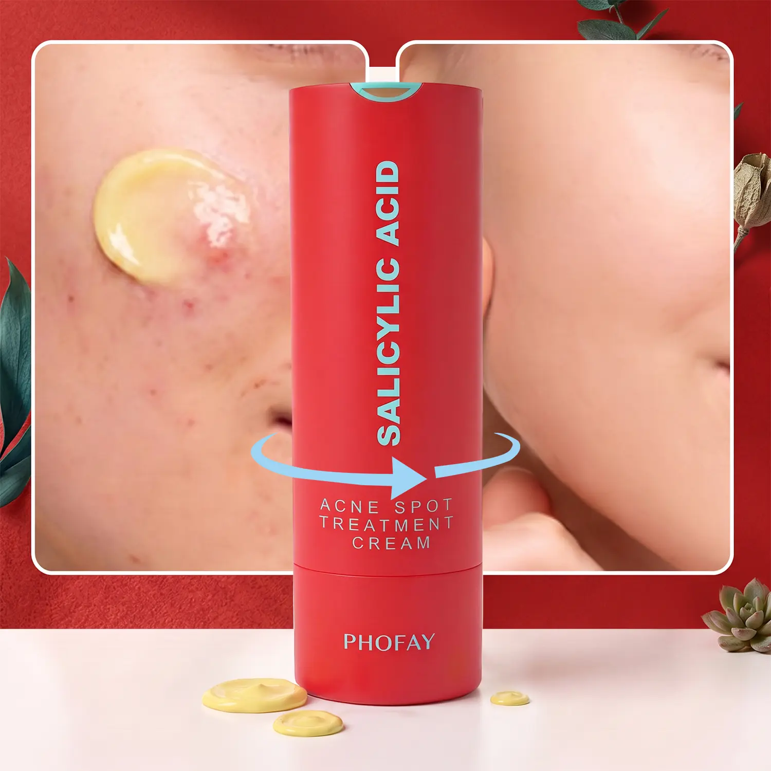 Drying Lotion | Pimple Treatment & Body Acne Treatment | Visibly Shrinks Pimples & Helps Fade Acne Marks | With 1% Encapsulated Salicylic Acid, Niacinamide & Centella Asiatica Root Extract