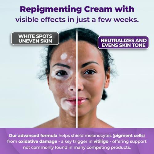 Vitiligo Cream for White Spots (4oz) - Repigmenting Cream with Polypodium Leucotomos and Melanocyte Support - Evens Skin Tone and Reduces Discoloration by Aura Dermacare