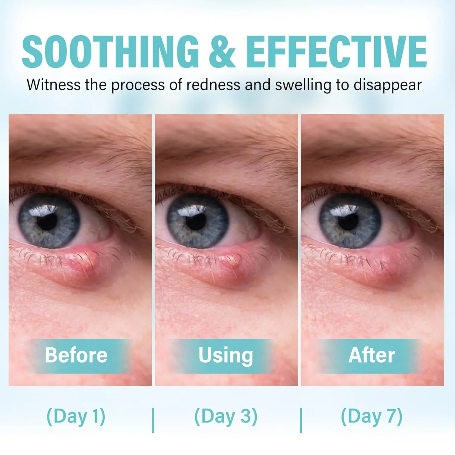 Stye Eye Treatment, Effective Stye Eye Relief Drop, for Styes ...