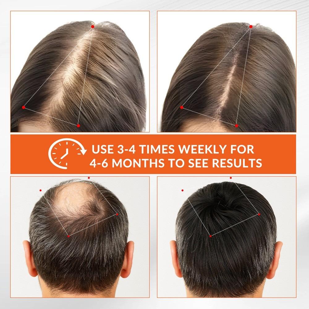 Red Light Therapy Cap for Hair Regrowth, 660nm (72 LEDs) & 850nm (144 LEDs) Near Infrared Phototherapy Hat & Hair Bonnet, Reduce Hair Loss, Protect Scalp, Repair Follicles, Anti-Thinning, Adjustable Pulse Modes, Hands-Free Home Use Festival Gift