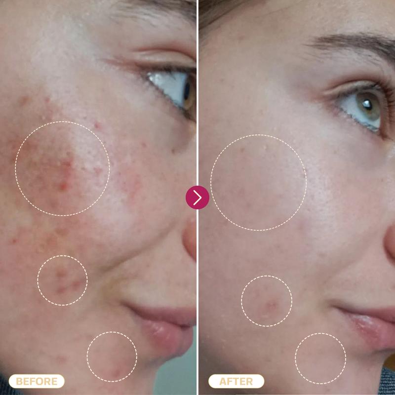 Base Laboratories Hypochlorous Acid Spray & Wipes Bundle - 75 Wipes & 8oz Spray for Acne Eczema Piercings & Irritations Fast Relief for Daily Use