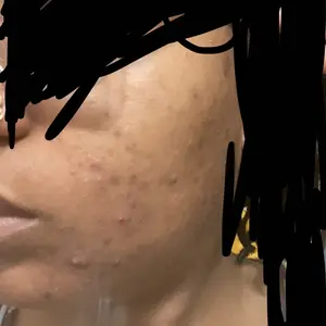 Product Review of Lion Pair Acne Cream Acne Treatment Pimples Removal Cream Pair Acne Creamy Foam Facial Wash Gentle Antibacterial from ❣**︎