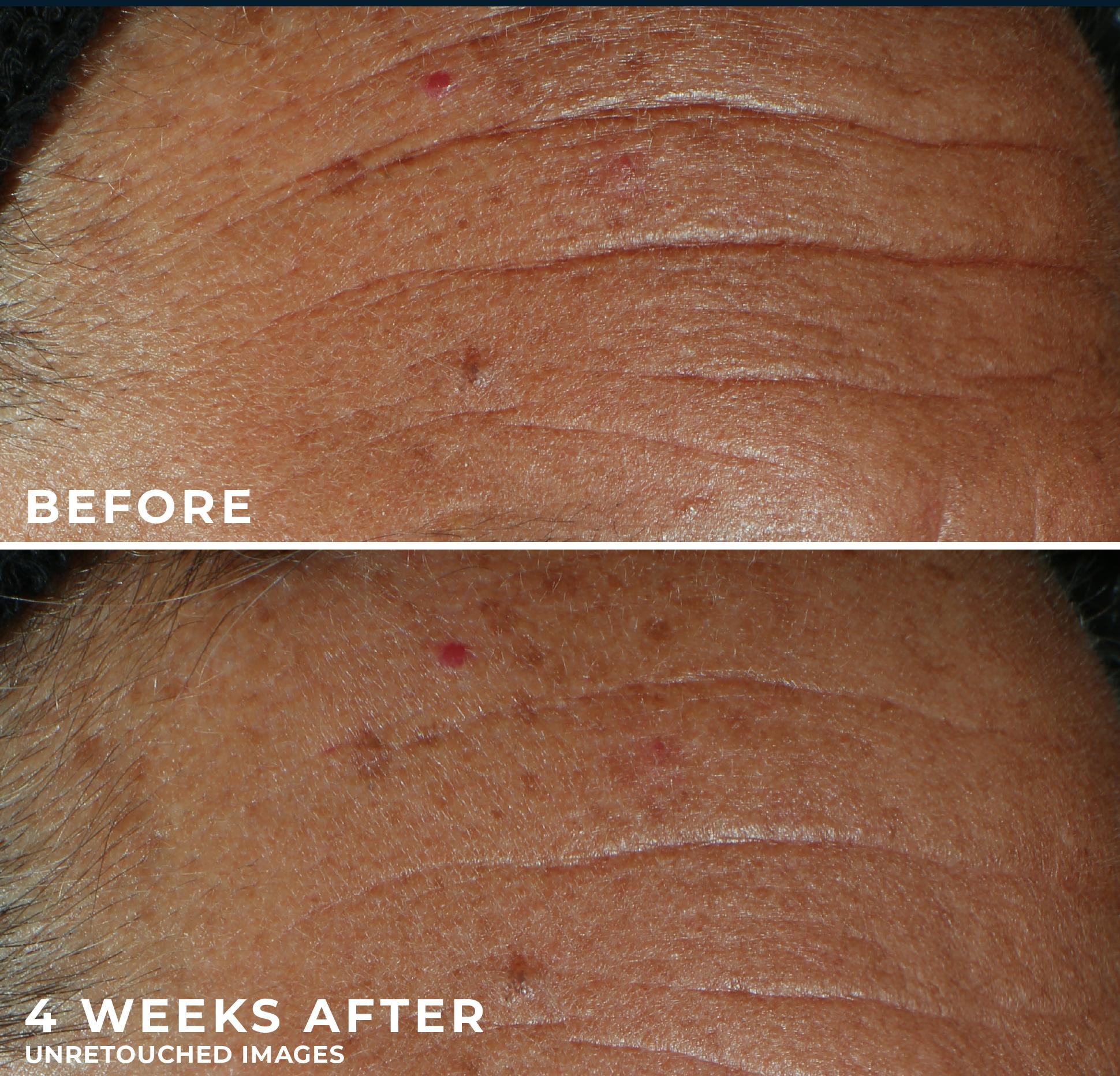 [RoC Skincare] DERM CORREXION Fill + Treat Serum