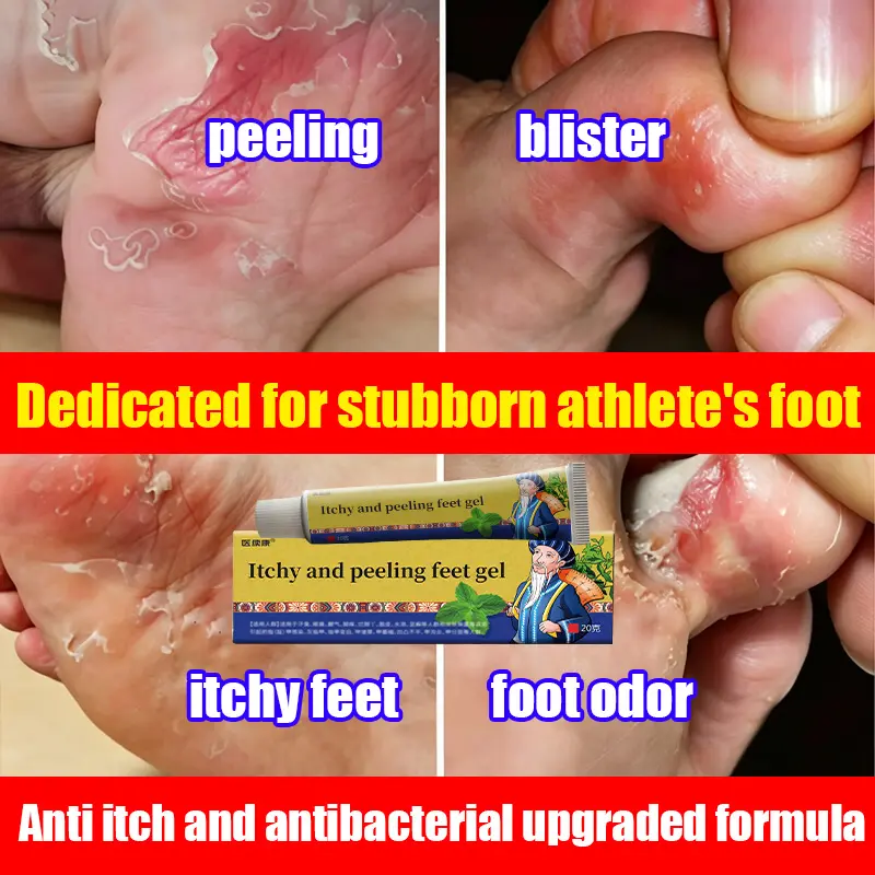 This foot type antibacterial and anti itch ointment can effectively alleviate the foot blisters, peeling, itching, pain, erosion, and odor caused by bacterial infections in athletes' feet, especially the erosion and blisters between toes
