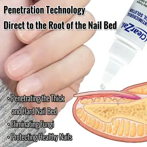 ClearZal Antimicrobial BAC Nail Solution Fungal Nail Treatment 1 Ounce Kills Fungus, Bacteria and Viruses Nail Care [combination partner]