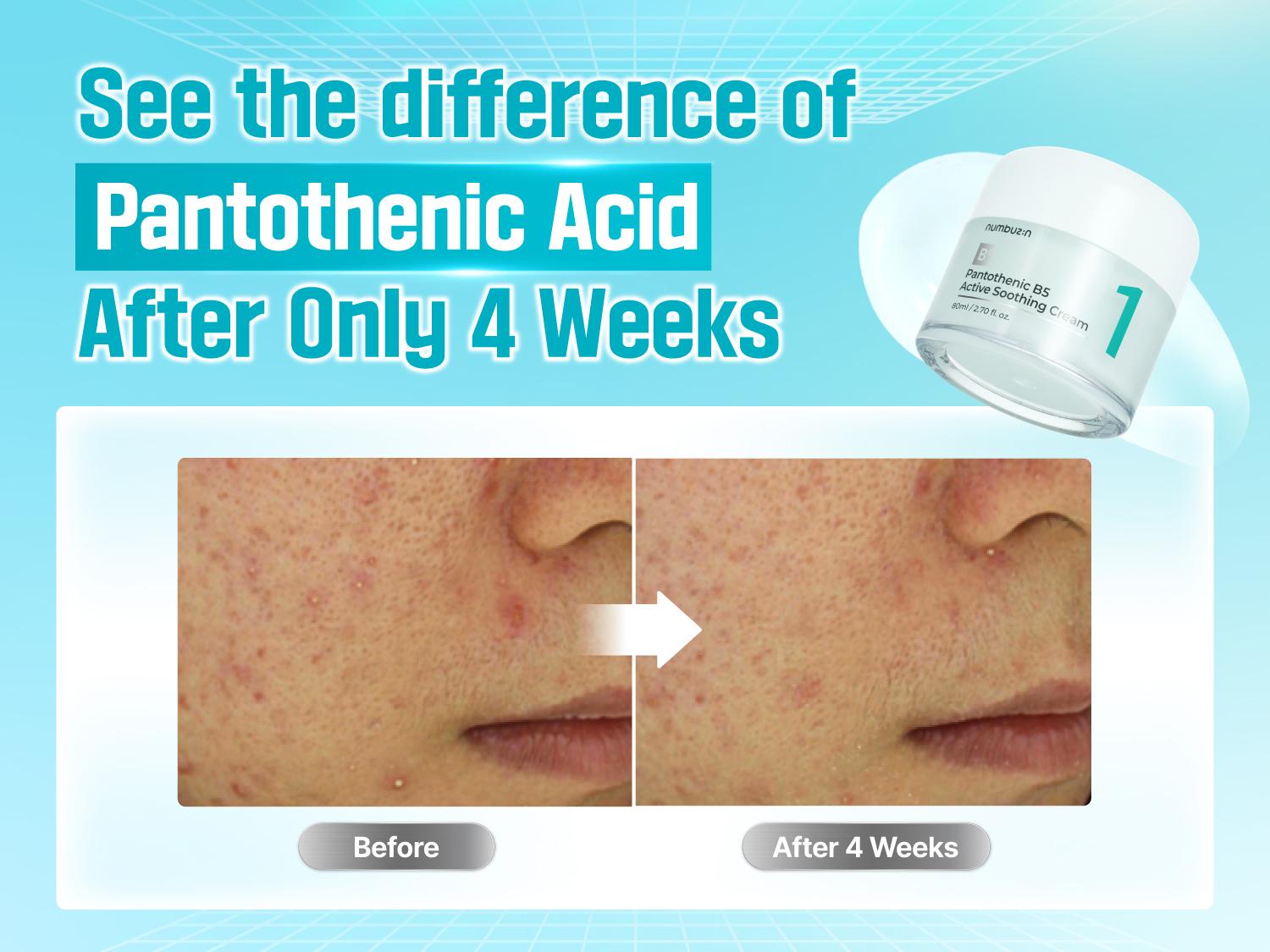 [numbuzin official shop] No.1 Acne Pantotenic Acid Set | No.1 Serum + Cream + Toner Pads + Powder