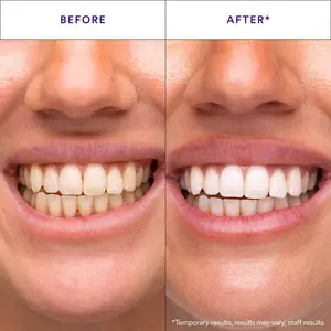 Teeth whitening strips for sensitive teeth, purple color corrector safe for enamel, stain remover, professional at-home dental whitening treatment, 14 count