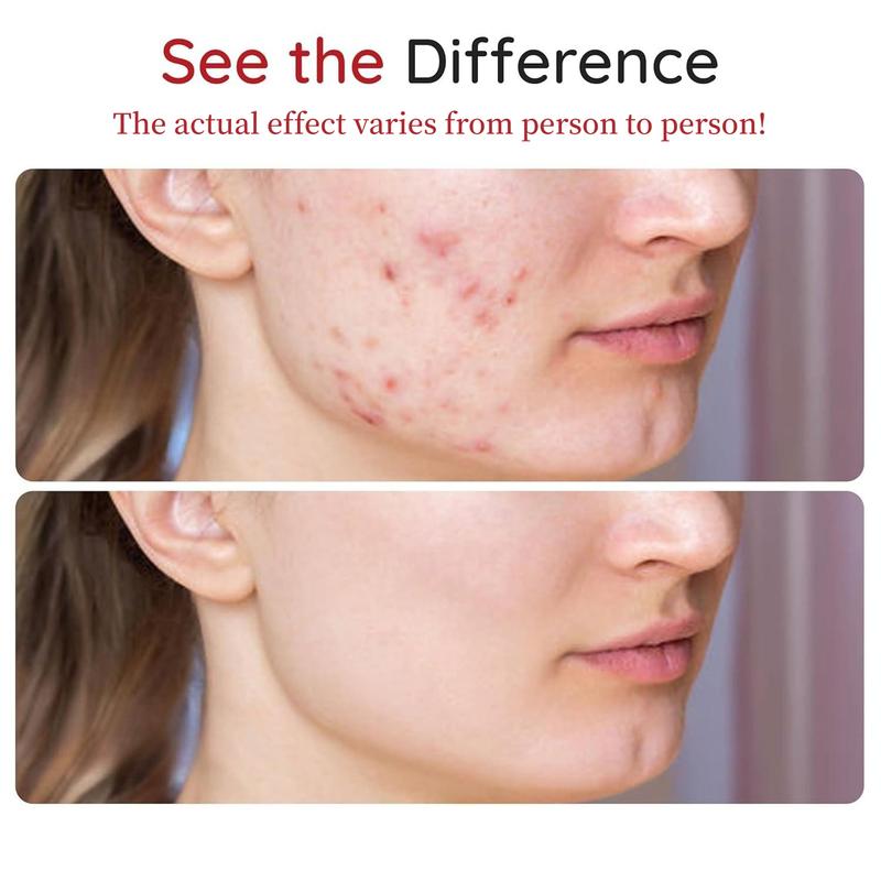 450 Count Pimple Patches for Face Hydrocolloid Acne Patch Bulk Acne Stickers for Cheeks Forehead Chin Blemishes Zit Breakouts for All Skin Types Black Friday Deals