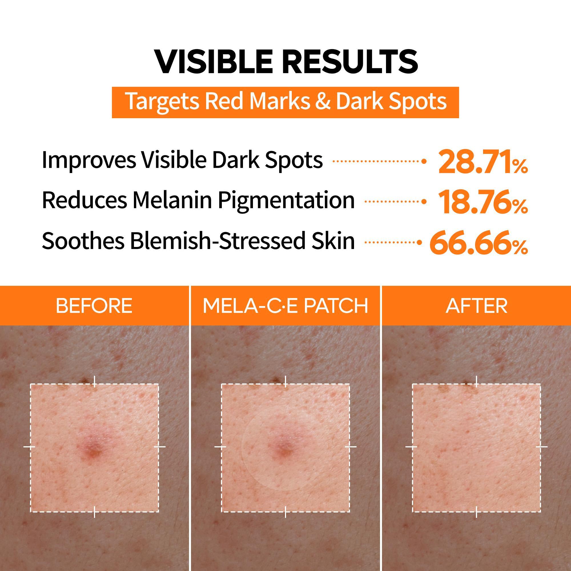 [Dr.Melaxin Official] Zero-Fit Blemish & Dark Spot Patch Duo 72 Patches × 2 | S-ZINC + Mela-C·E Ultra Thin Spot Patches with Salicylic Acid, Acne Care, Sulfur, Vitamin C & Niacinamide