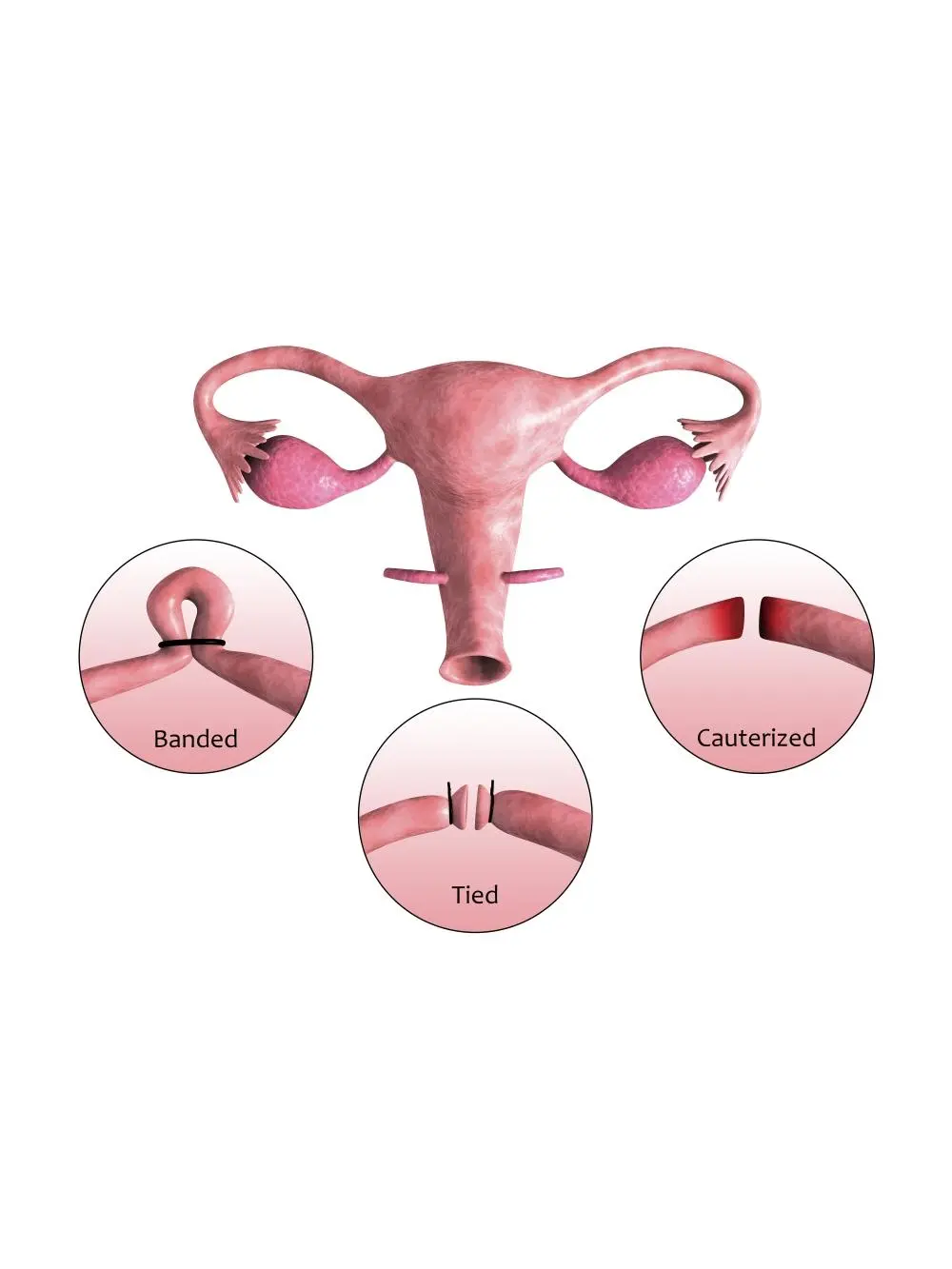 StockTrek Images Tubectomy Biomedical Illustration Poster Print, Artist: StockTrek Images, 35 x 23 in Wall Decor for Room Decor (Fallopian Tube Blockage Procedure Art)